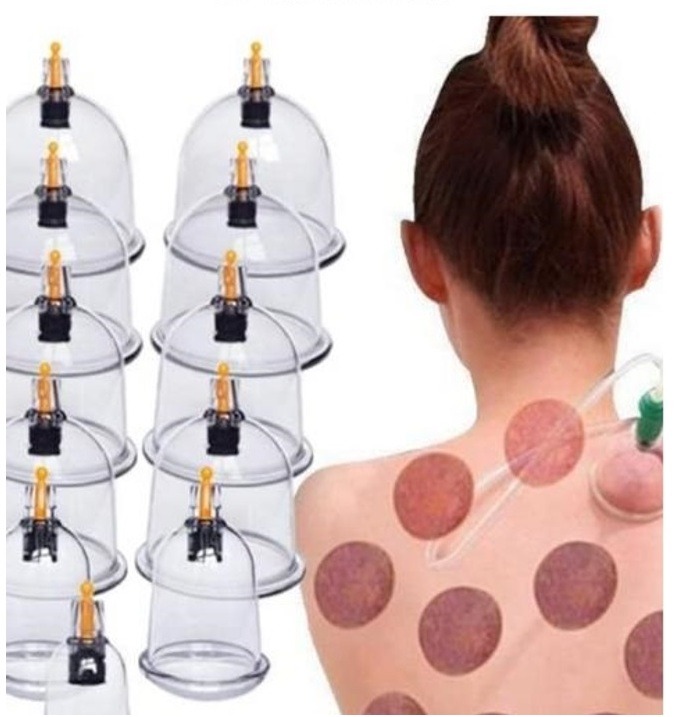 Professional cupping therapy treatment for pain relief at Prairie Osteopath in Regina, Saskatchewan