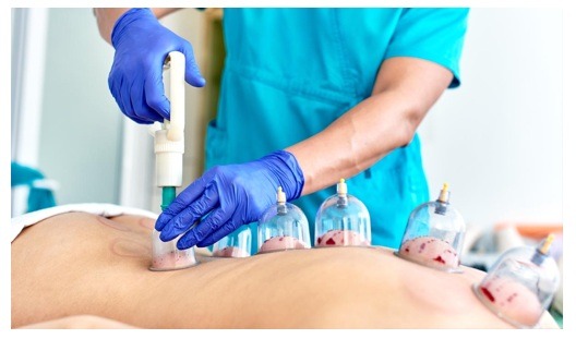 Photo shows Wet Cupping (Hijama)