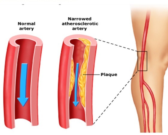 Narrow Vs Normal Vessel