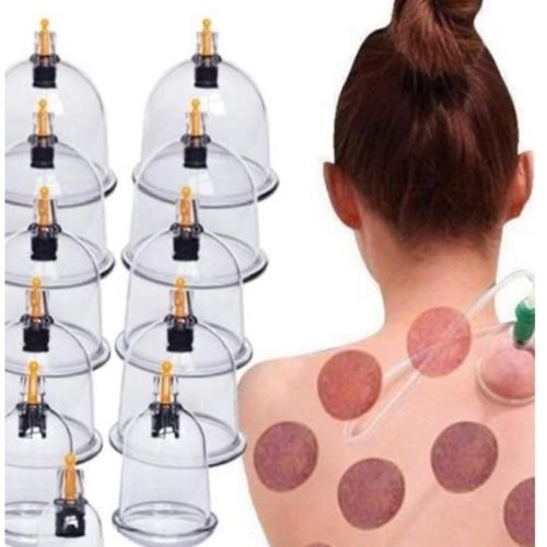 Professional cupping therapy treatment for pain relief at Prairie Osteopath in Regina, Saskatchewan
