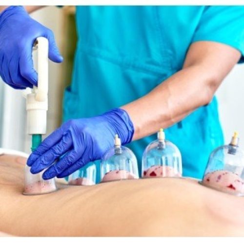 Photo shows Wet Cupping (Hijama)