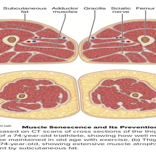 Photo Describing Healthy Muscles Vs Sedentary Muscles Atrophy